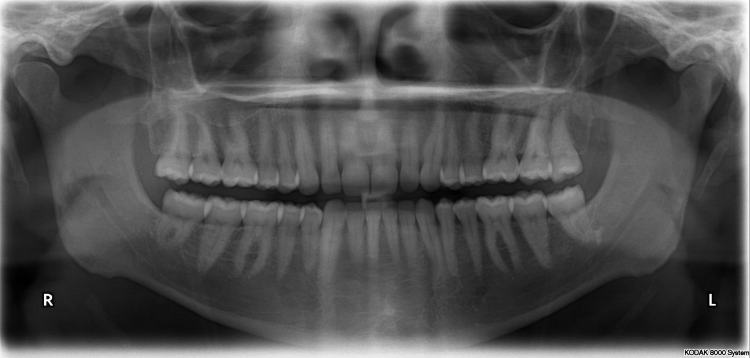 File:X-ray of all 32 human teeth.jpg - Wikimedia Commons
